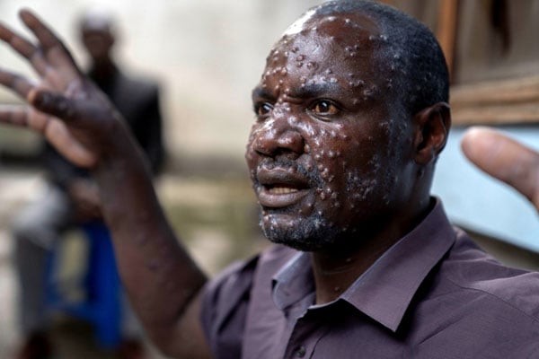 Panic as Mpox Confirmed in Oyam&nbsp;District